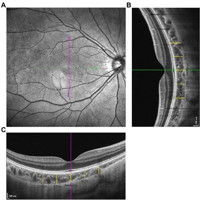 Assessment of Choroidal Vascularity and Choriocapillaris Blood Perfusion After Accommodation in Myopia, Emmetropia, and Hyperopia Groups Among Children